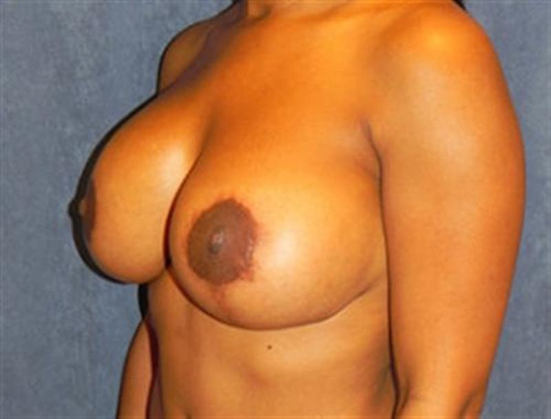 Breast Implant Revision Before & After Gallery - Patient 775767 - Image 2