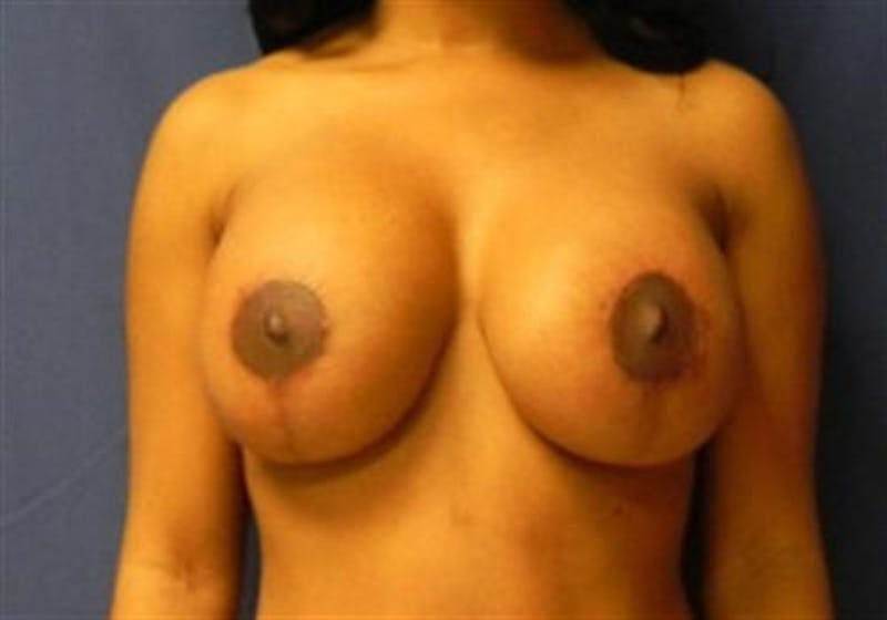 Breast Implant Revision Before & After Gallery - Patient 775767 - Image 4
