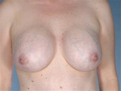 Breast Implant Revision Before & After Gallery - Patient 680979 - Image 1