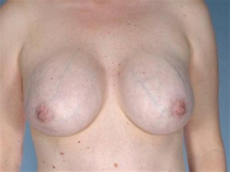 Breast Implant Revision Before & After Gallery - Patient 680979 - Image 1