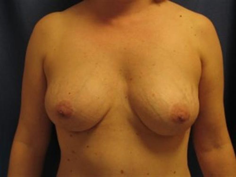 Breast Implant Revision Before & After Gallery - Patient 680979 - Image 2