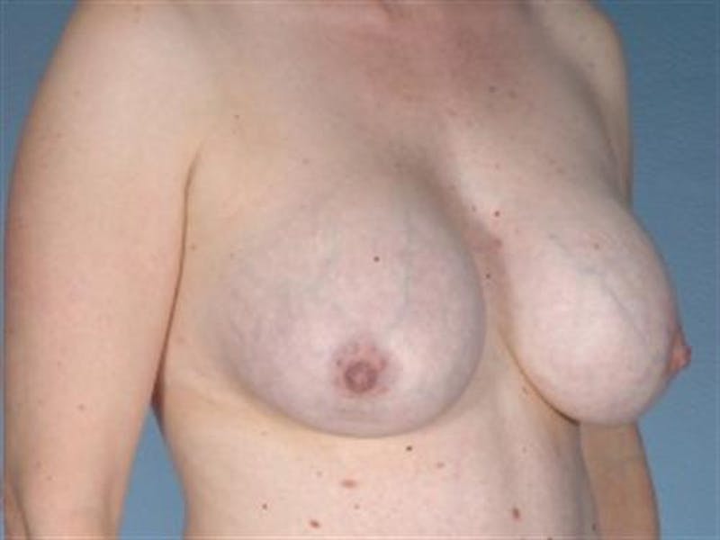 Breast Implant Revision Before & After Gallery - Patient 680979 - Image 3