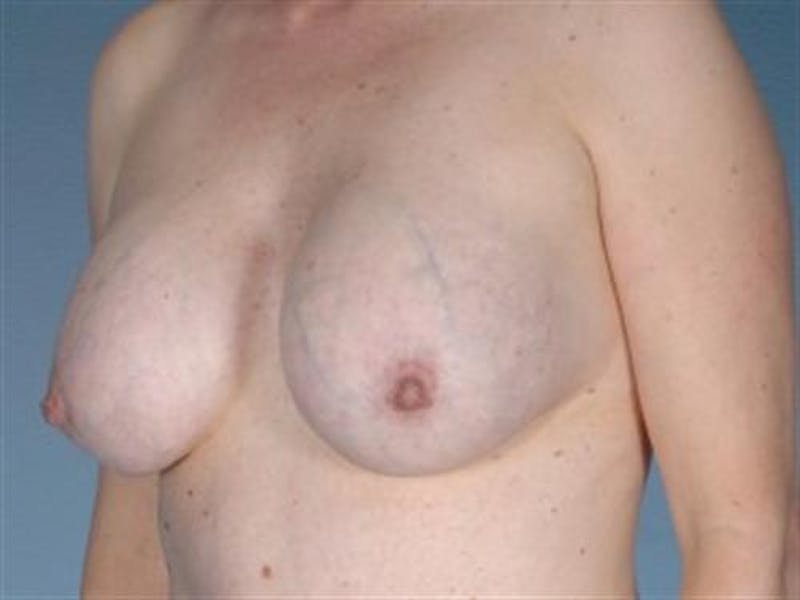 Breast Implant Revision Before & After Gallery - Patient 680979 - Image 5