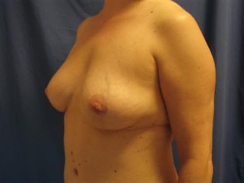 Breast Implant Revision Before & After Gallery - Patient 680979 - Image 6