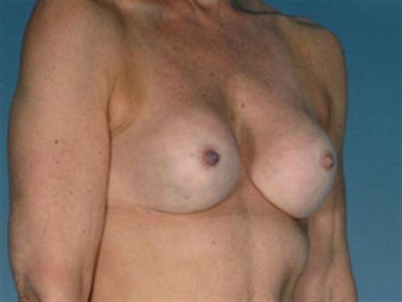 Breast Implant Revision Before & After Gallery - Patient 383722 - Image 1