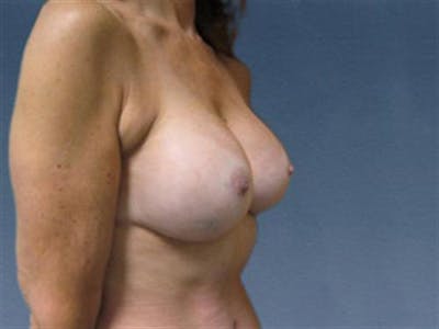 Breast Implant Revision Before & After Gallery - Patient 383722 - Image 2