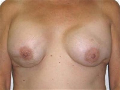 Breast Implant Revision Before & After Gallery - Patient 225023 - Image 1