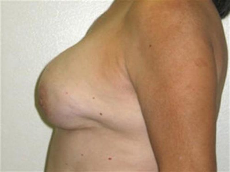 Breast Implant Revision Before & After Gallery - Patient 225023 - Image 3