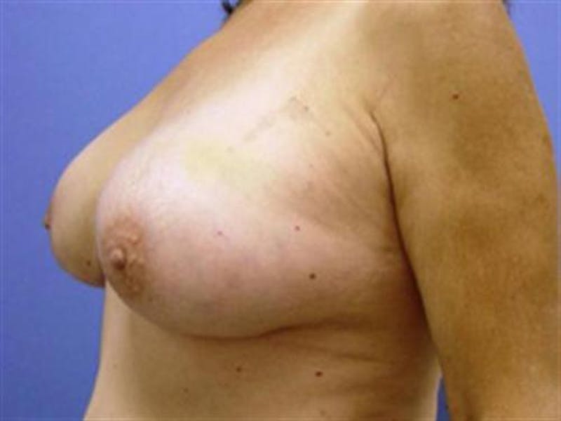 Breast Implant Revision Before & After Gallery - Patient 225023 - Image 4