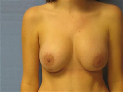 Breast Implant Revision Before & After Gallery - Patient 333830 - Image 2