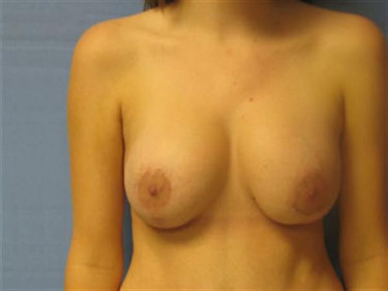 Breast Implant Revision Before & After Gallery - Patient 333830 - Image 2