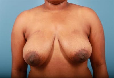 Breast Lift Before & After Gallery - Patient 933391 - Image 1