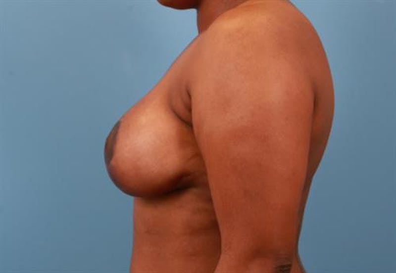 Breast Lift Before & After Gallery - Patient 933391 - Image 4