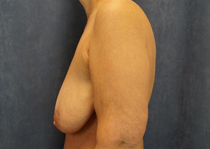 Breast Lift Before & After Gallery - Patient 226948 - Image 3