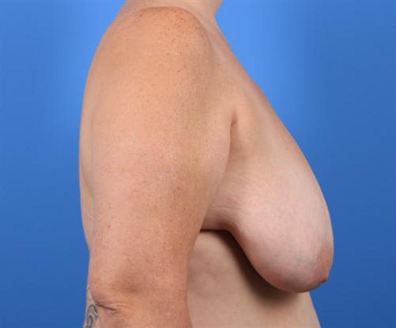 Breast Lift Before & After Gallery - Patient 181818 - Image 3