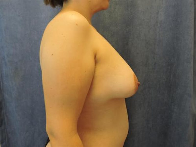 Breast Lift Before & After Gallery - Patient 367851 - Image 3