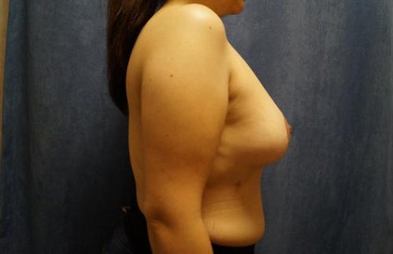Breast Lift Before & After Gallery - Patient 367851 - Image 4