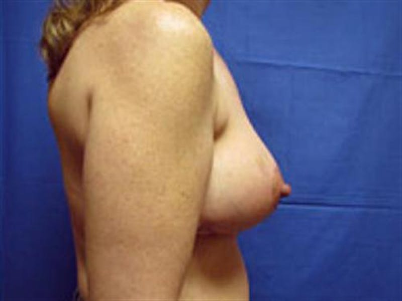 Breast Lift Before & After Gallery - Patient 118231 - Image 2