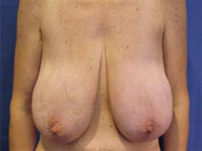Breast Lift Before & After Gallery - Patient 365067 - Image 1