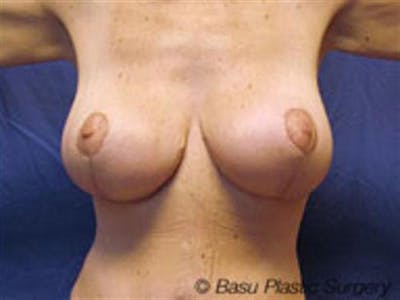 Breast Lift Before & After Gallery - Patient 365067 - Image 2