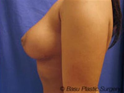 Breast Lift Before & After Gallery - Patient 223019 - Image 2