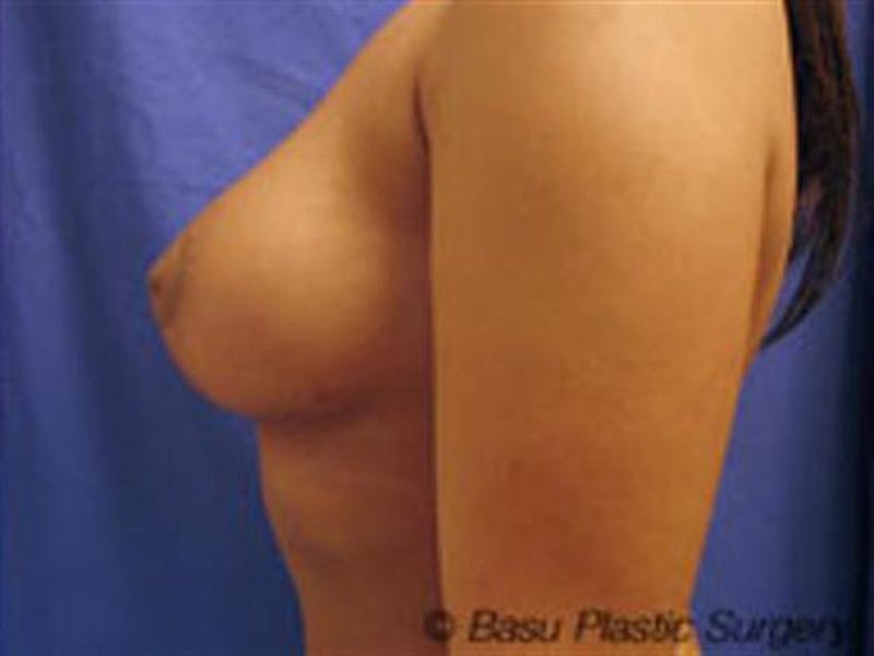 Breast Lift Before & After Gallery - Patient 223019 - Image 2