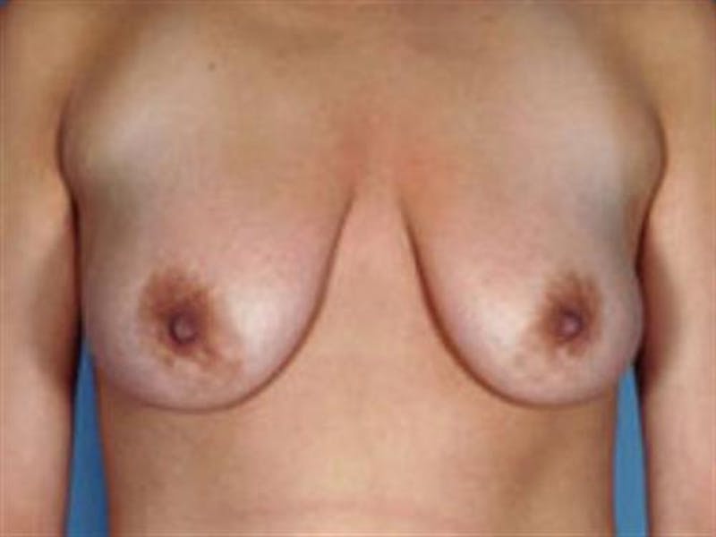 Breast Lift Before & After Gallery - Patient 255250 - Image 1