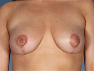 Breast Lift Before & After Gallery - Patient 255250 - Image 2