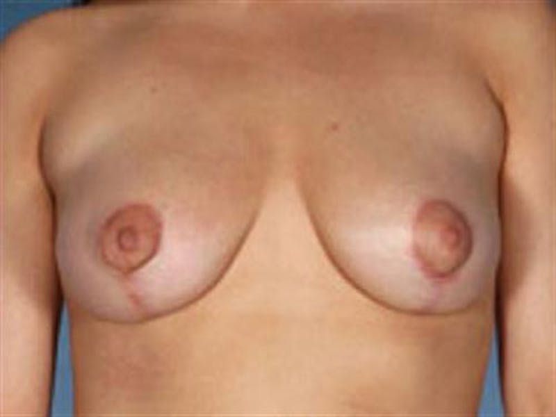 Breast Lift Before & After Gallery - Patient 255250 - Image 2