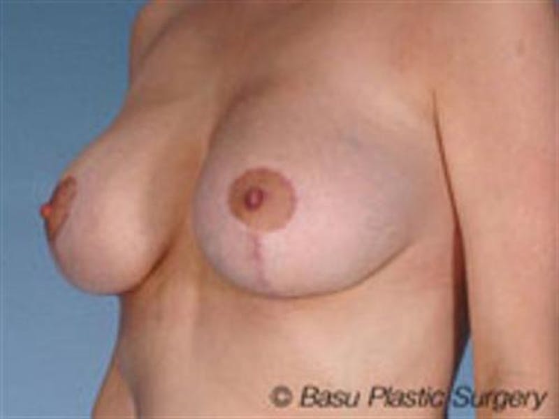 Breast Lift Before & After Gallery - Patient 264439 - Image 2