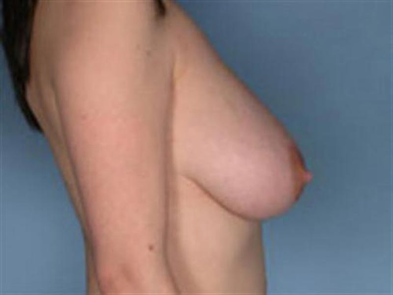 Breast Lift Before & After Gallery - Patient 264439 - Image 3