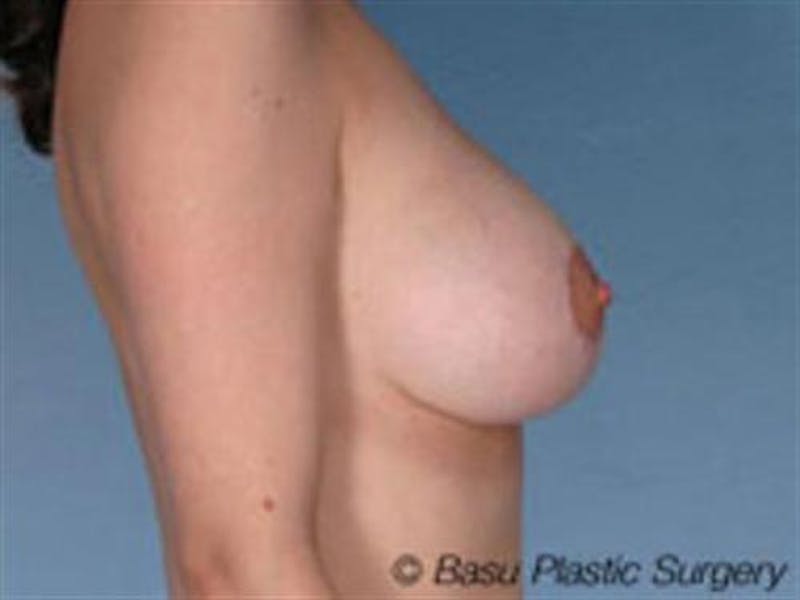 Breast Lift Before & After Gallery - Patient 264439 - Image 4