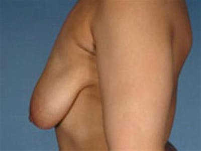 Breast Lift Before & After Gallery - Patient 776692 - Image 1
