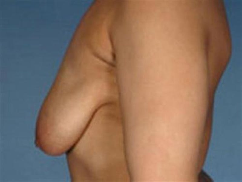 Breast Lift Before & After Gallery - Patient 776692 - Image 1