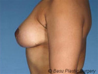 Breast Lift Before & After Gallery - Patient 776692 - Image 2