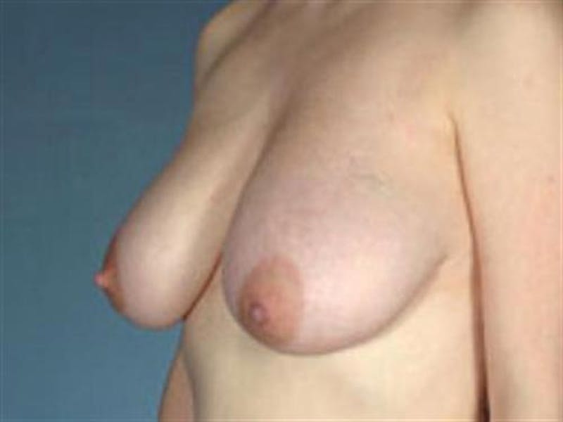 Breast Lift Before & After Gallery - Patient 189113 - Image 1