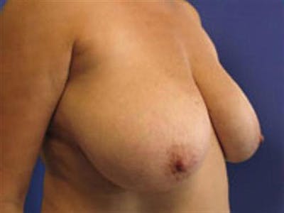 Breast Lift Before & After Gallery - Patient 286227 - Image 1