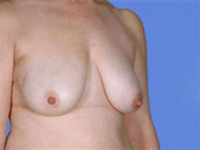 Breast Lift Before & After Gallery - Patient 280060 - Image 1