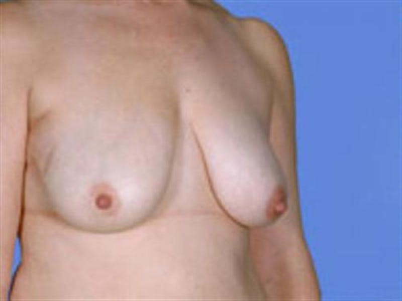 Breast Lift Before & After Gallery - Patient 280060 - Image 1