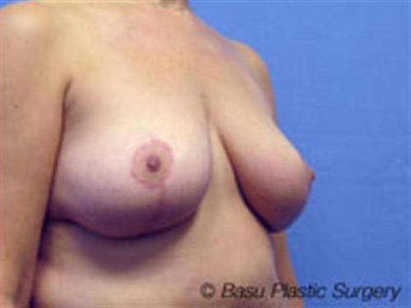 Breast Lift Before & After Gallery - Patient 280060 - Image 2