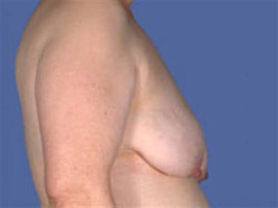 Breast Lift Before & After Gallery - Patient 106148 - Image 1