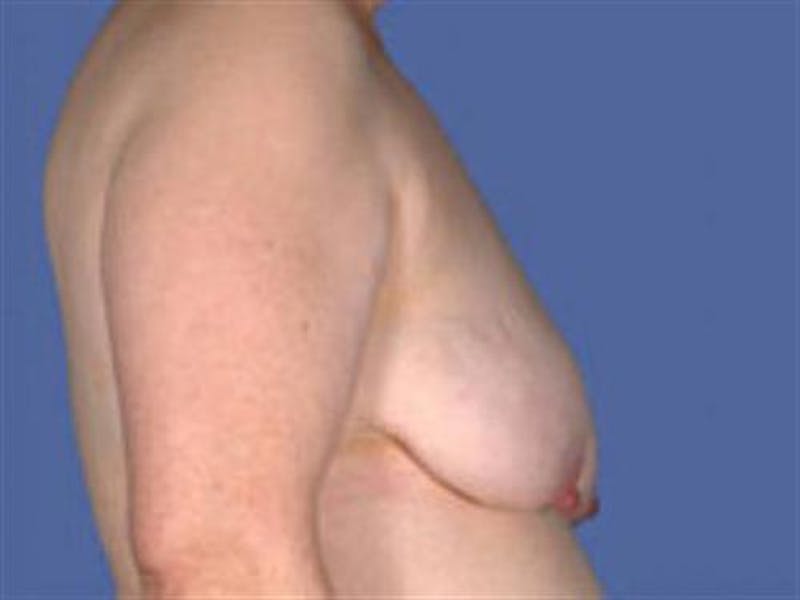 Breast Lift Before & After Gallery - Patient 106148 - Image 1