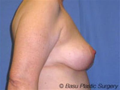 Breast Lift Before & After Gallery - Patient 106148 - Image 2
