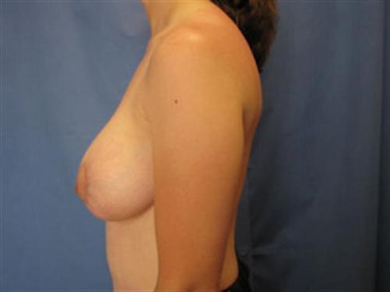 Breast Lift Before & After Gallery - Patient 290210 - Image 2