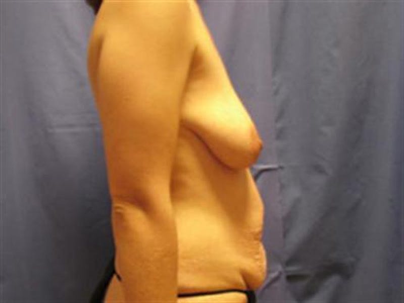 Breast Lift Before & After Gallery - Patient 290210 - Image 3