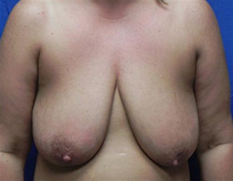 Breast Lift Before & After Gallery - Patient 309876 - Image 1