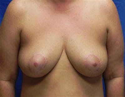 Breast Lift Before & After Gallery - Patient 309876 - Image 2