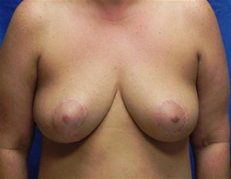 Breast Lift Before & After Gallery - Patient 309876 - Image 2