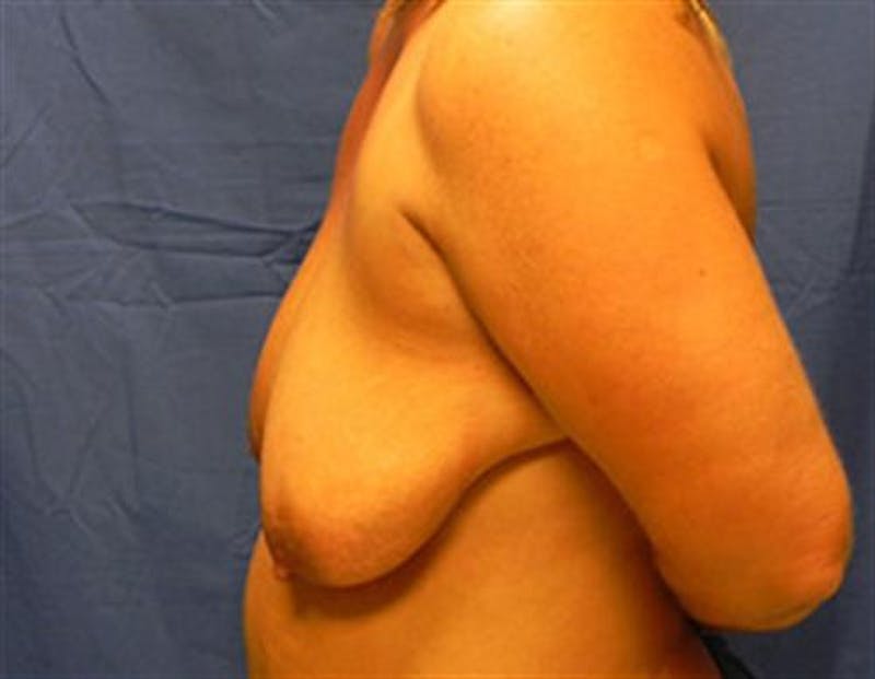 Breast Lift Before & After Gallery - Patient 309876 - Image 5