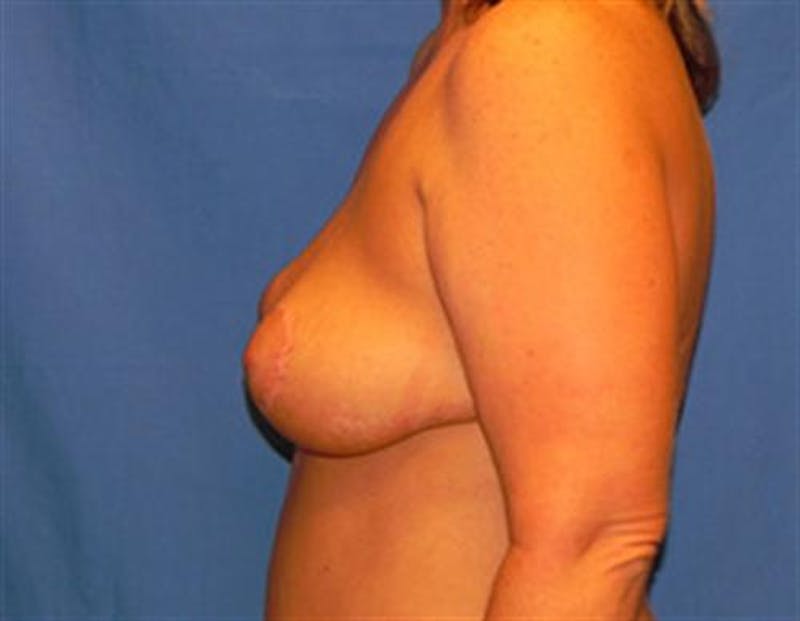 Breast Lift Before & After Gallery - Patient 309876 - Image 6
